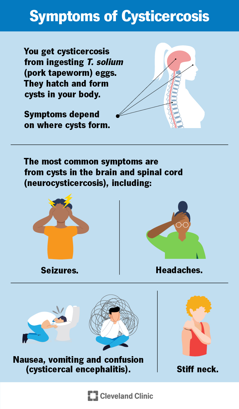 I sintomi comuni della cisticercosi sono convulsioni, mal di testa, torcicollo, vomito e confusione, ma dipendono da dove si trovano le cisti.