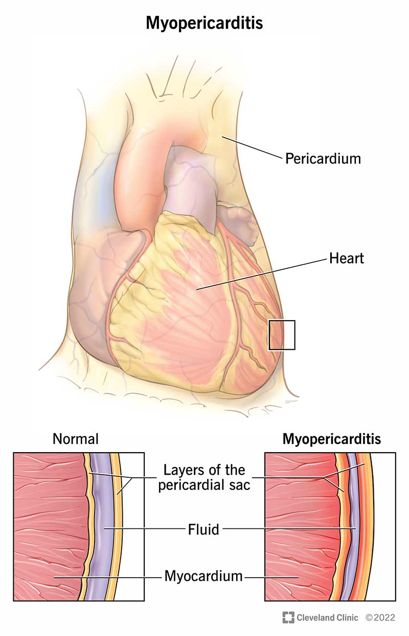 Miopericardite o infiammazione che colpisce il pericardio e il miocardio.