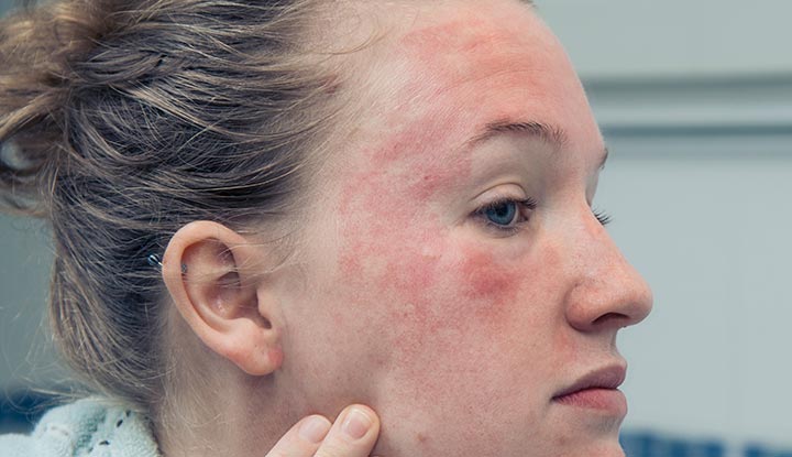 24604 eczema on face