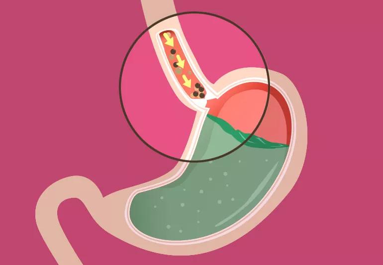 achalasia Illst 525226320