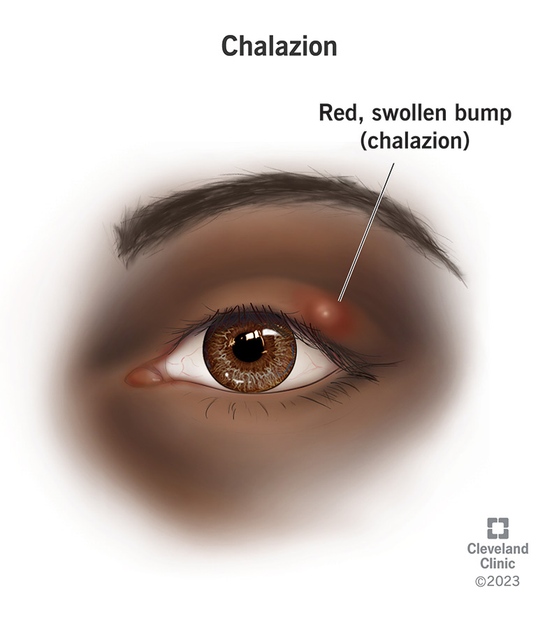 chalazion