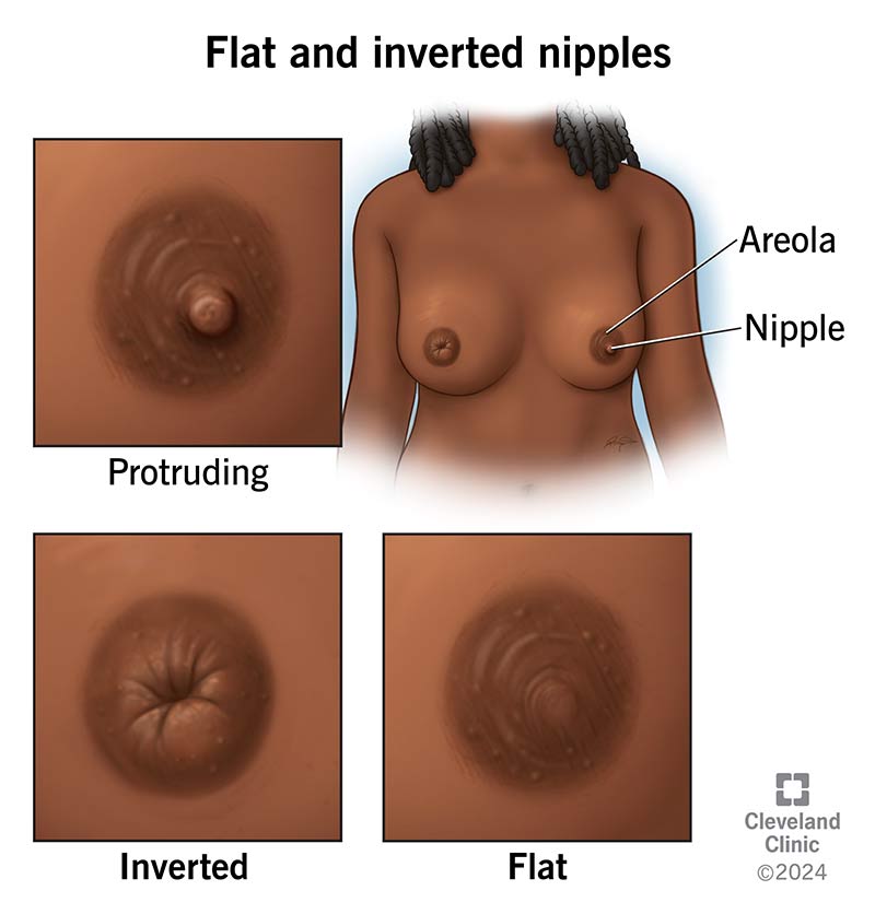 flat inverted nipples