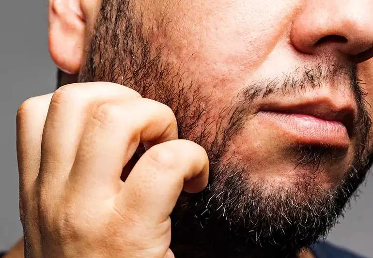 itchy beard 1136462491 770x533 1 jpg