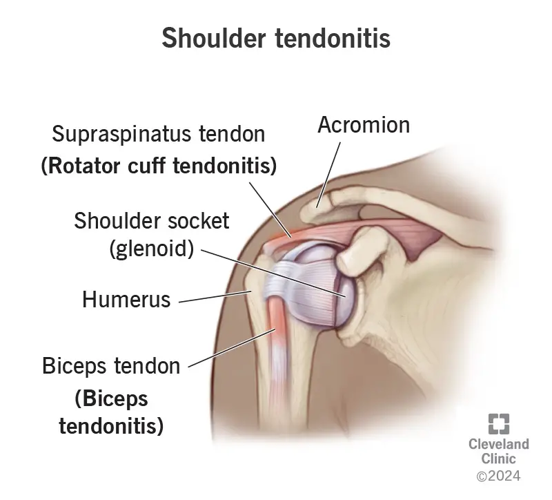 shoulder tendonitis