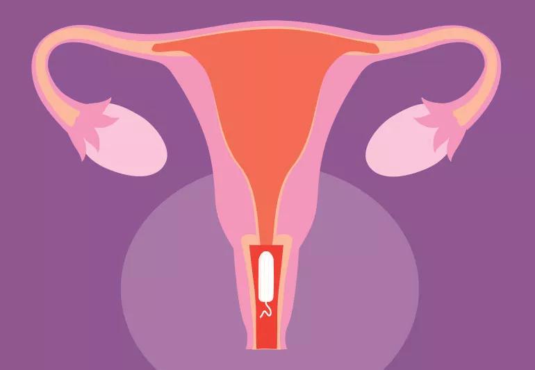 tampon in uterus 1253922218 770x533 1 jpg