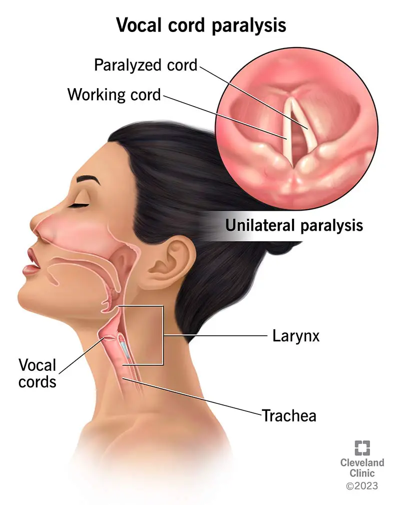 vocal cord paralysis