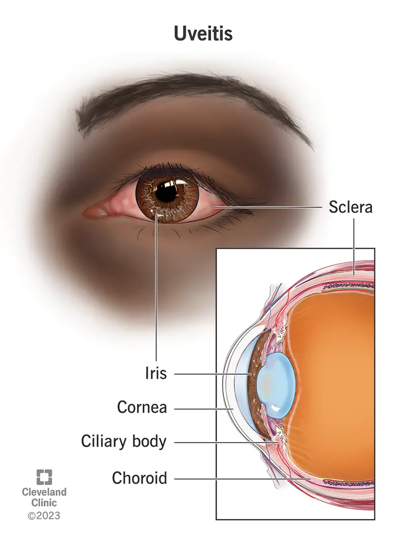 L'iride, il corpo ciliare e la coroide costituiscono l'uvea dell'occhio e l'uveite è l'infiammazione di uno o più di questi tre