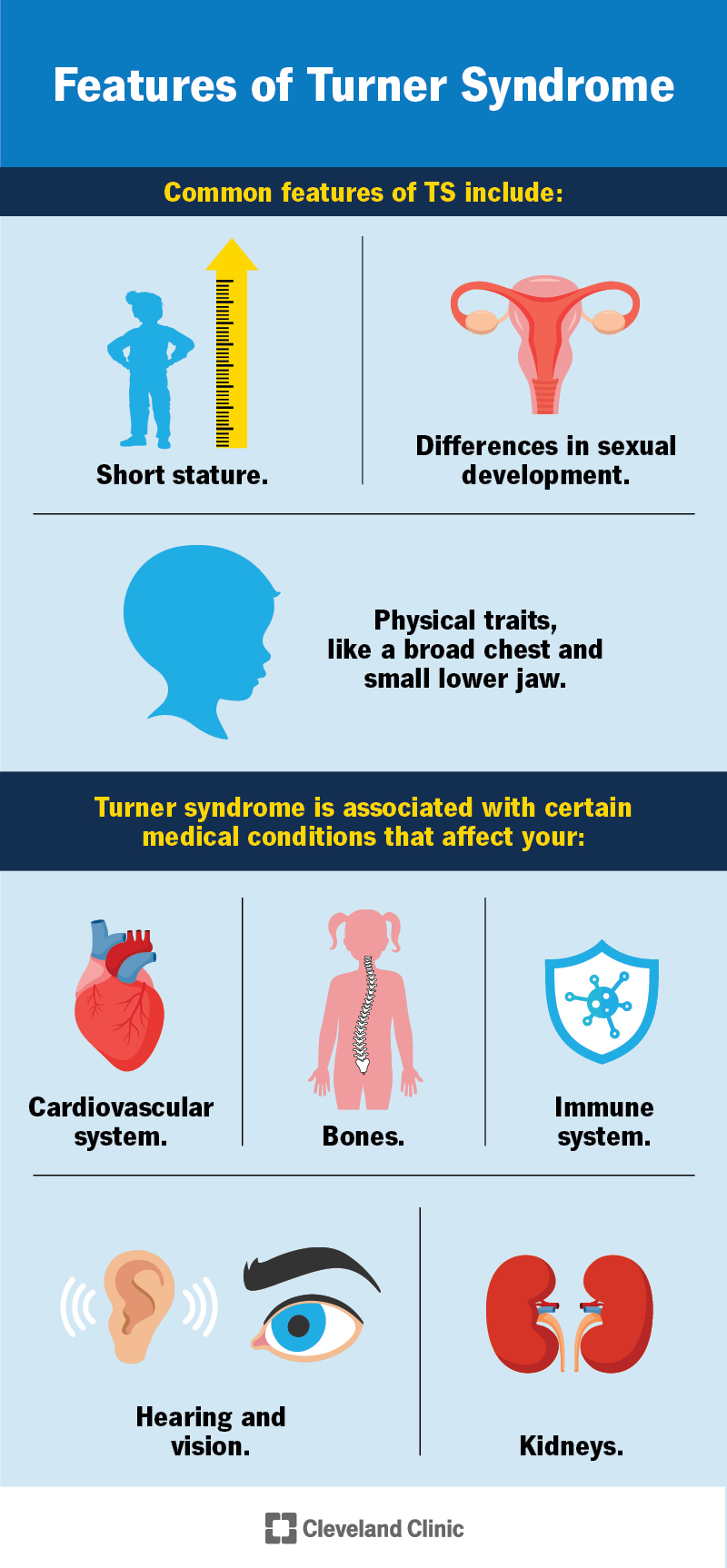 Le caratteristiche comuni della sindrome di Turner includono bassa statura, differenze nello sviluppo sessuale e alcuni tratti fisici.