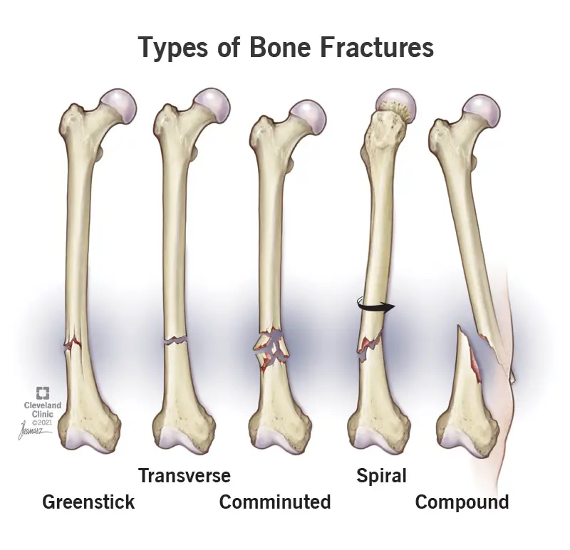 15241 bone fractures 2