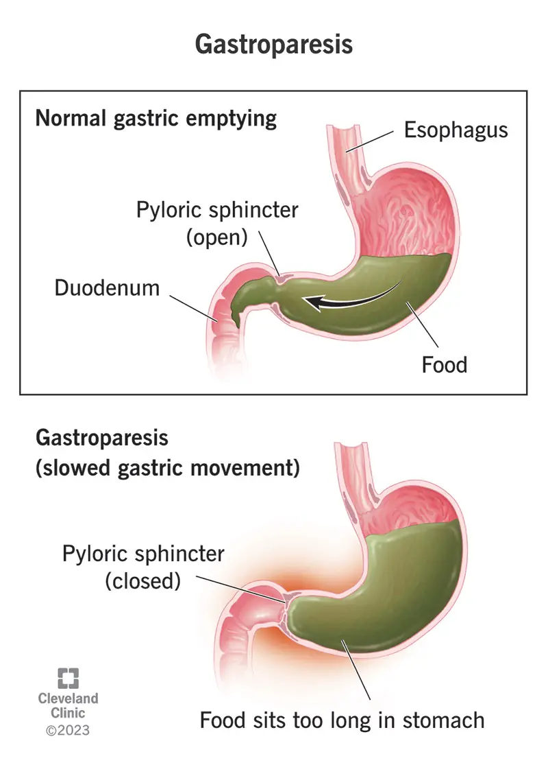 Nella gastroparesi, il cibo non riesce a muoversi normalmente attraverso lo stomaco.