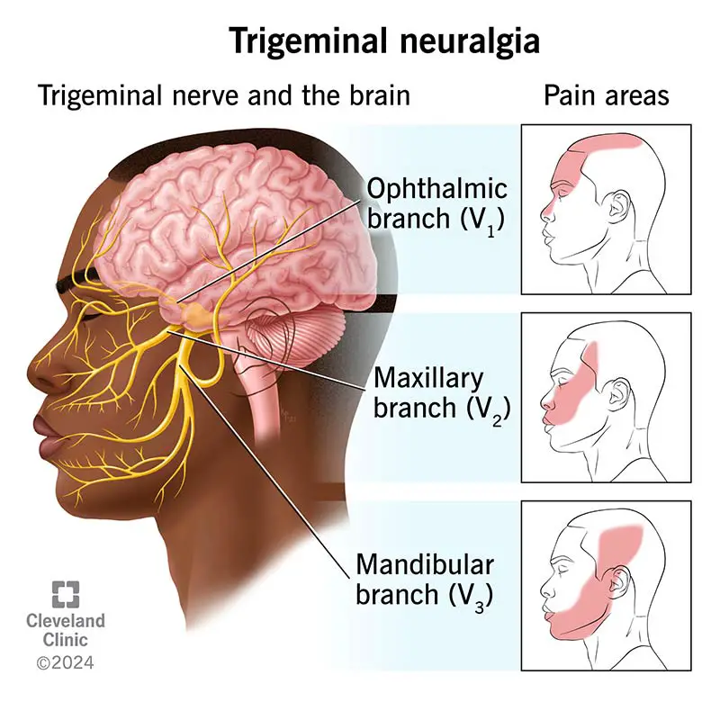 15671 trigeminal neuralgia