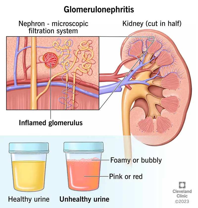 16167 glomerulonephritis