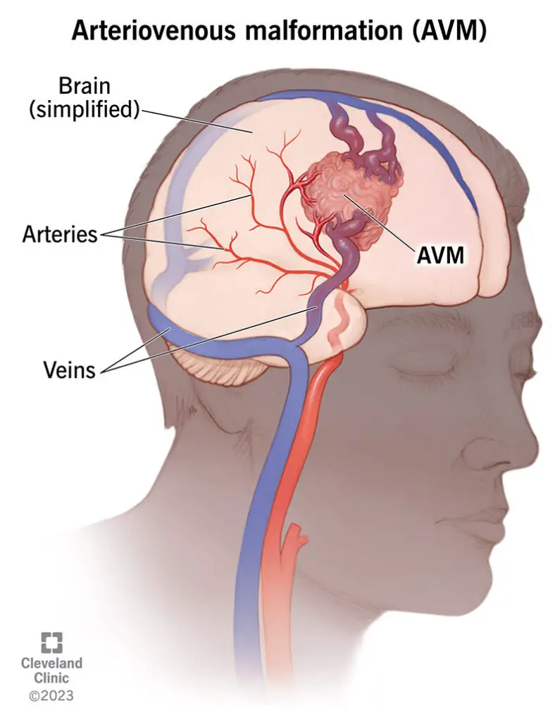 16755 arteriovenous malformation avm