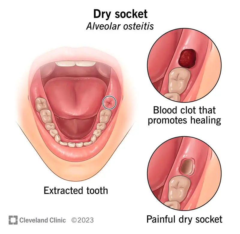 17731 dry socket