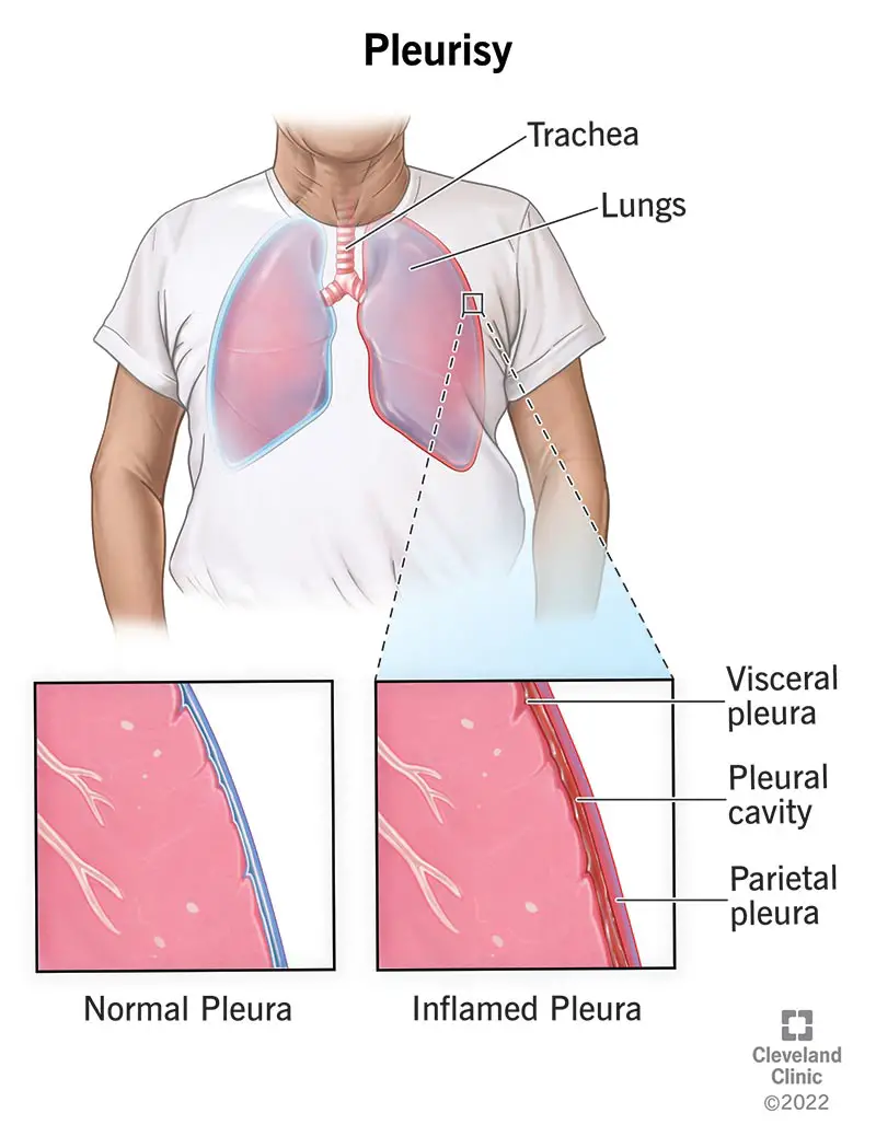 Illustrazione della pleura normale attorno ai polmoni confrontata con la pleura infiammata della pleurite.