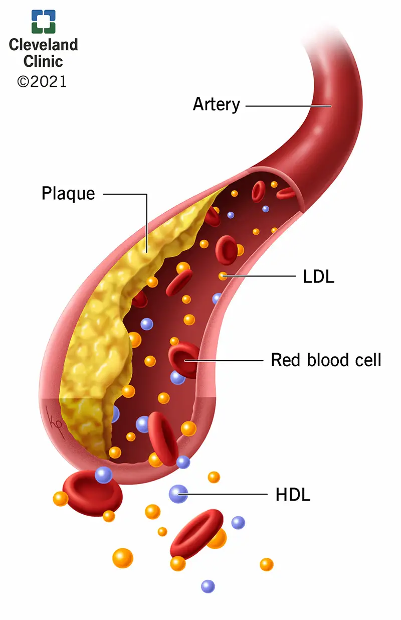 LDL, HDL e placca all'interno di un'arteria.