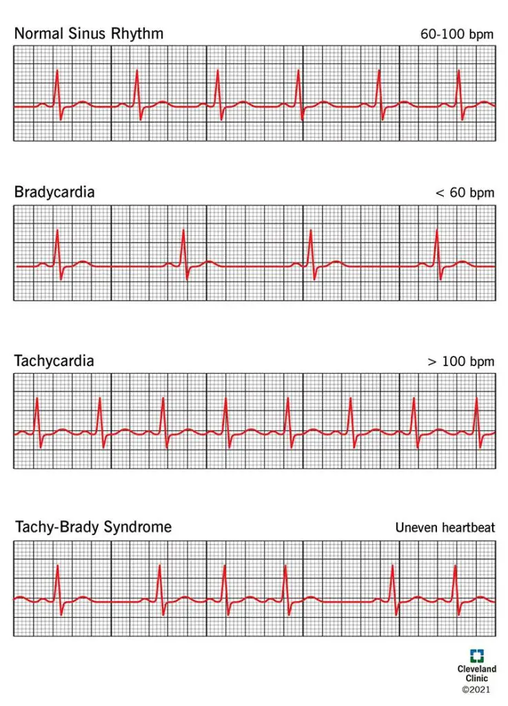 21789 sick sinus syndrome illustration.ashx