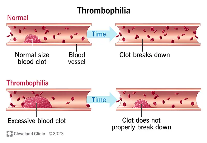 21797 thrombophilia illustration