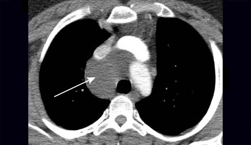 22107 bronchogenic cysts