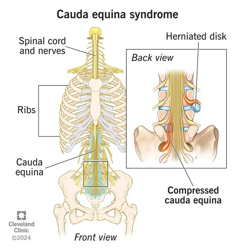 22132 cauda equina syndrome