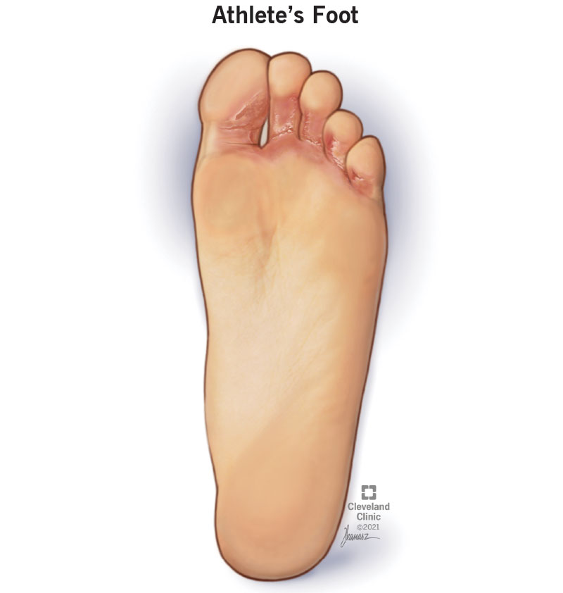 22139 athletes foot