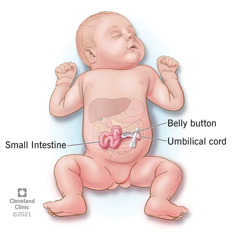 22290 gastroschisis