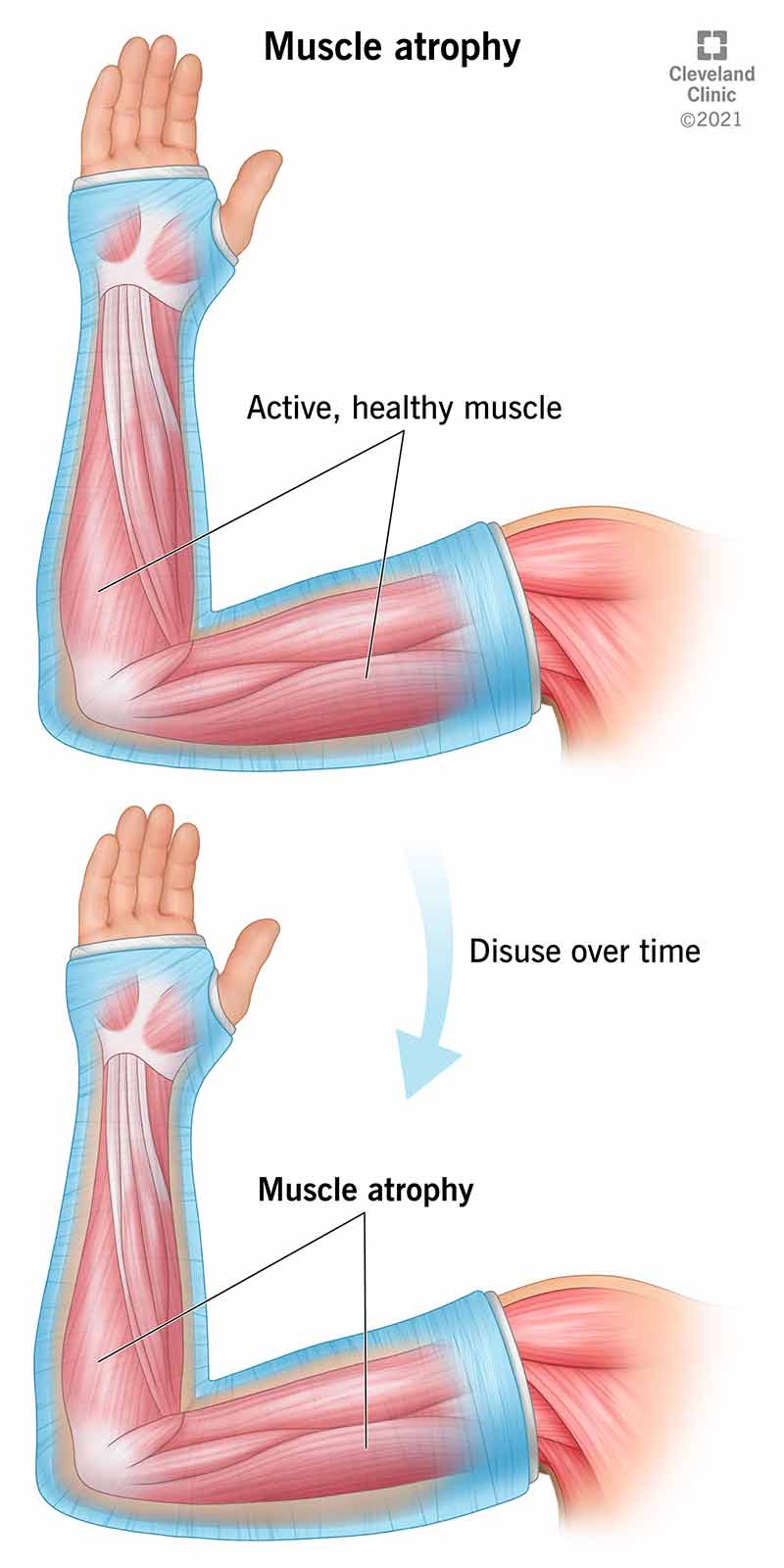 atrofia muscolare