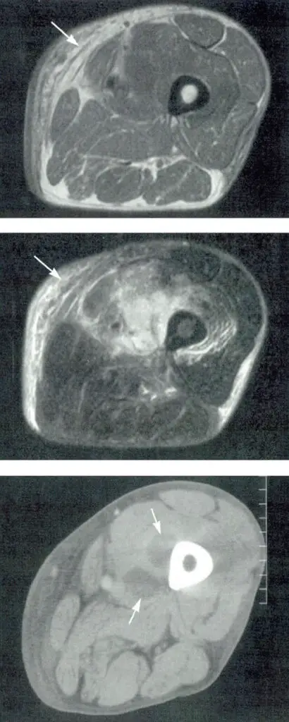 22408 pyomyositis