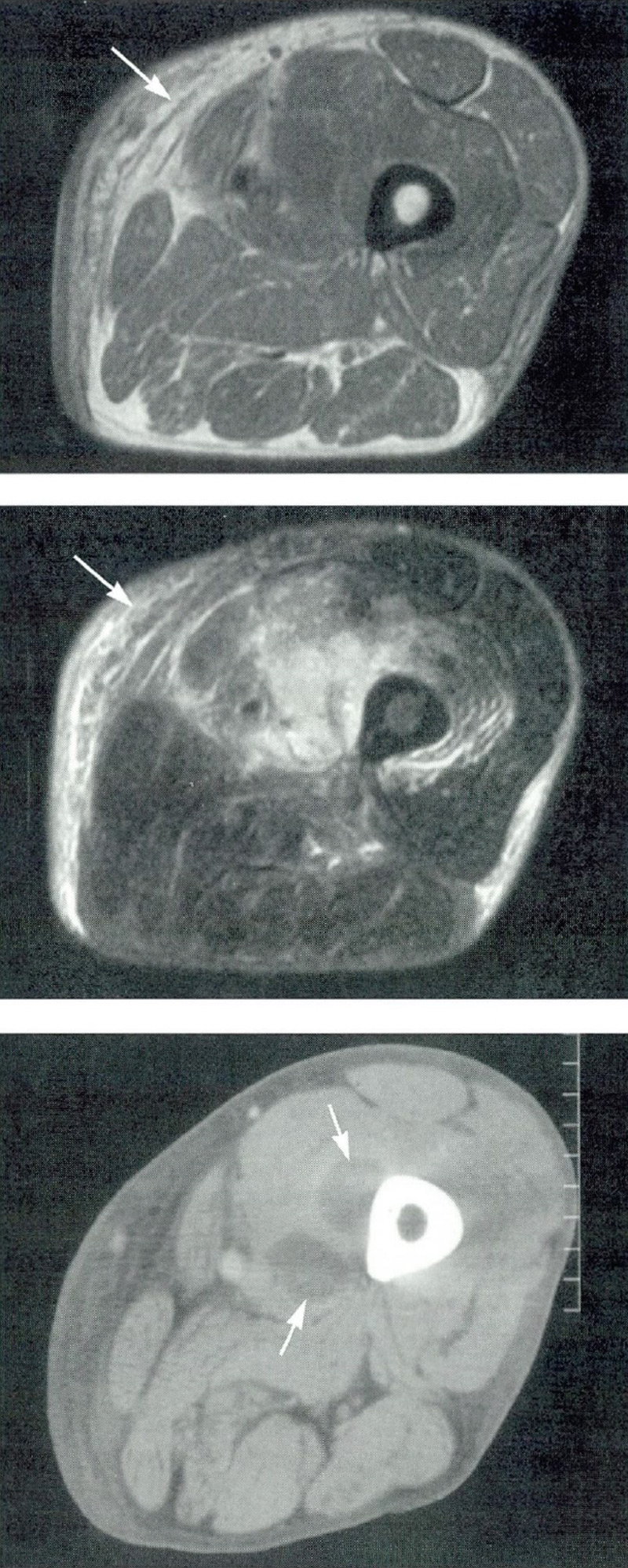 Le immagini MRI (le due immagini in alto) mostrano un'infiammazione nel tessuto della coscia. La scansione TC (immagine in basso) mostra un ascesso (piomiosite) che si è formato vicino all'osso della coscia (femore).