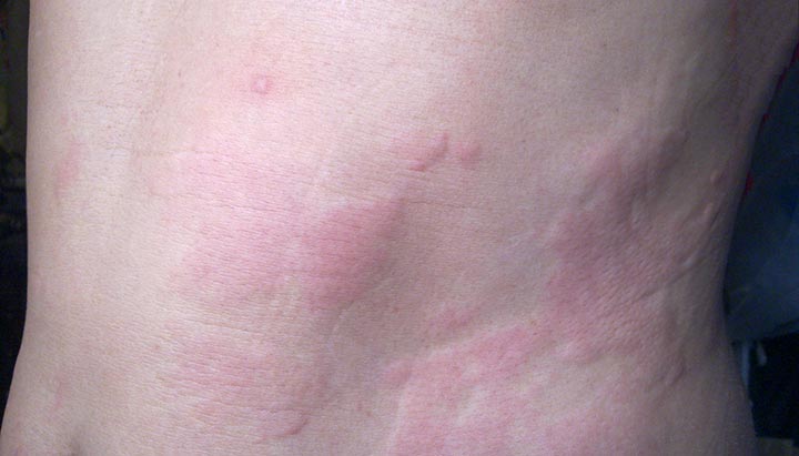 22900 chronic hives