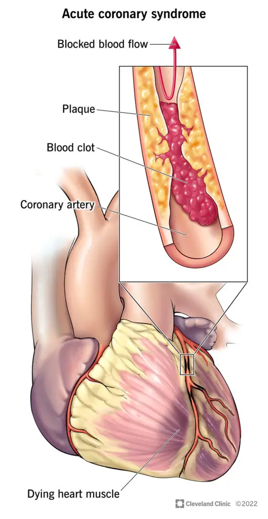 22910 acute coronary syndrome