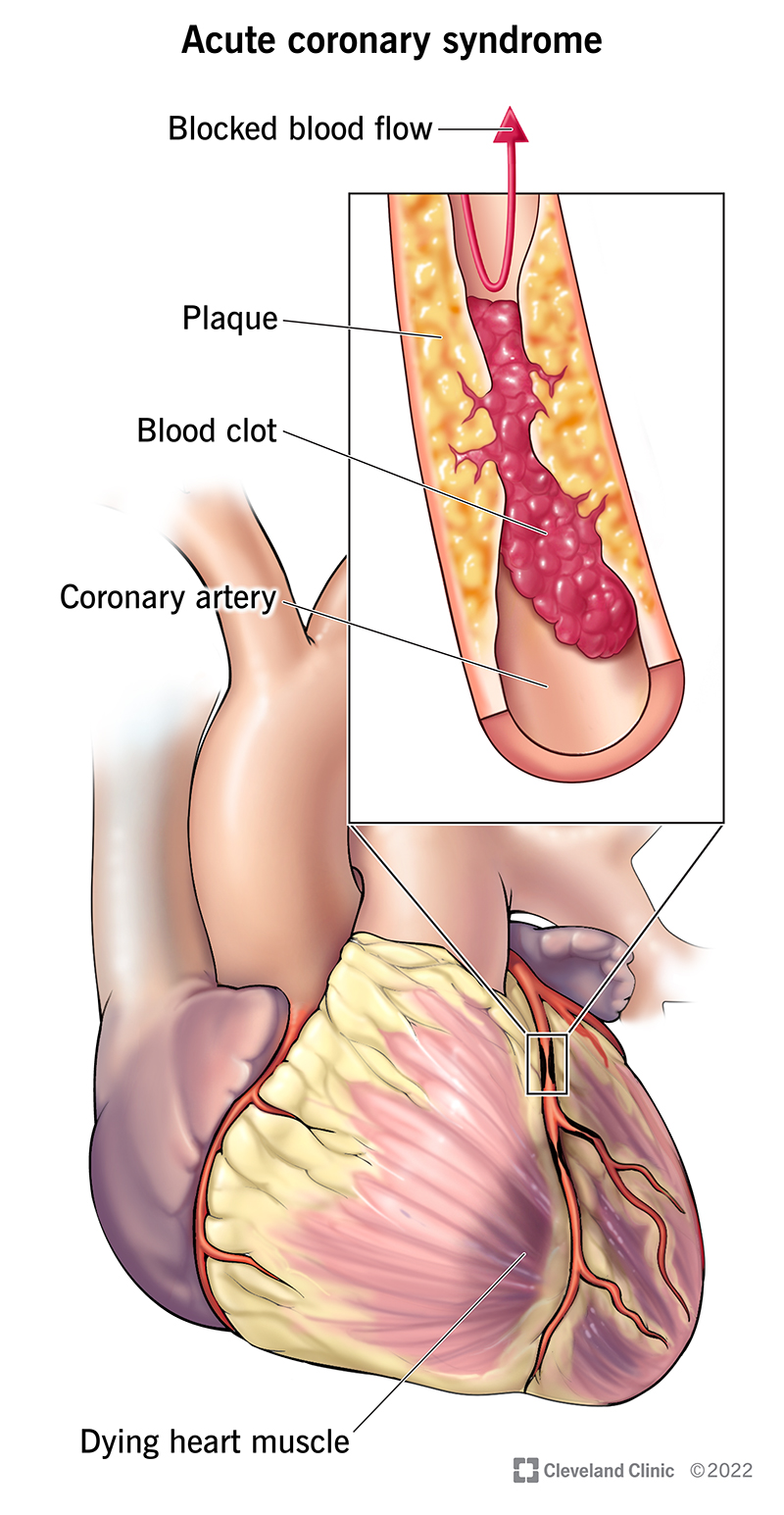 Nella sindrome coronarica, la placca restringe l'arteria coronaria e si forma un coagulo di sangue, impedendo all'ossigeno di raggiungere il muscolo cardiaco, che inizia a morire.