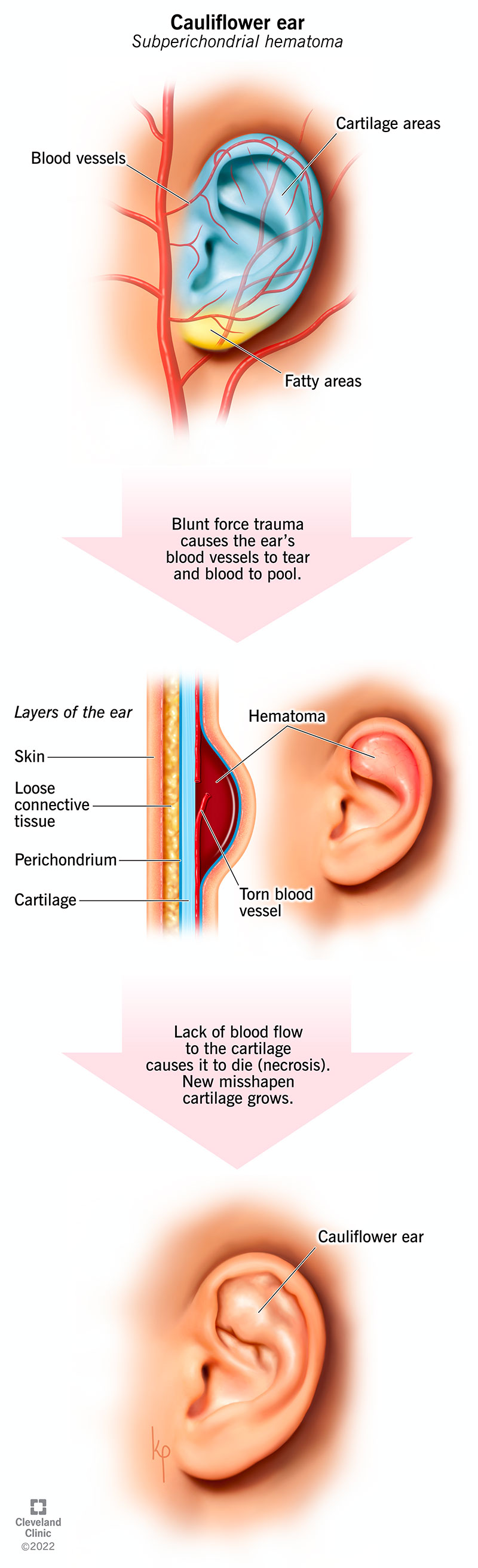 Diagramma di flusso che mostra come un trauma contundente provoca l'orecchio a cavolfiore.