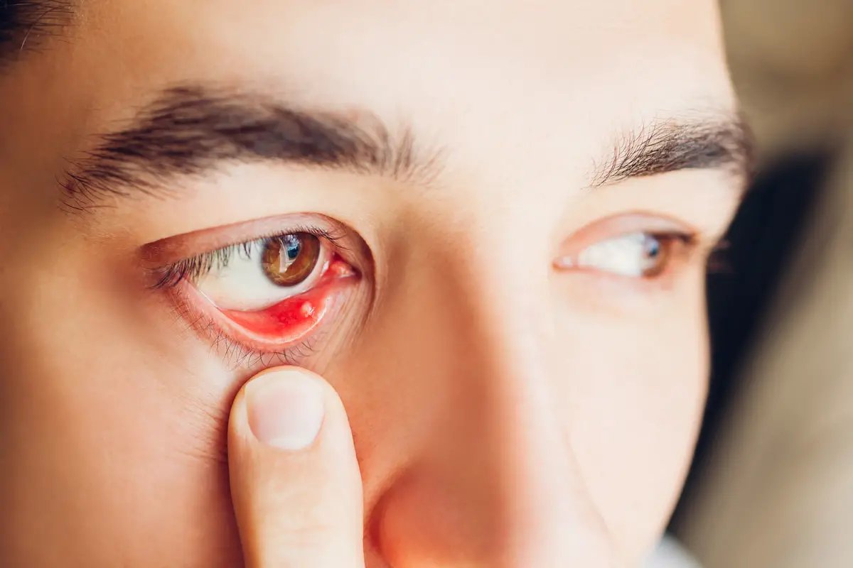 Fotografia di un orzaiolo interno sul lato interno della palpebra inferiore.