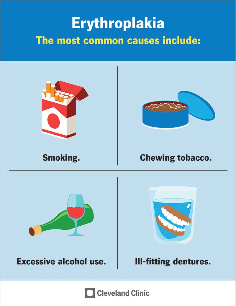 Le cause dell'eritroplachia includono protesi dentarie non adatte, fumo e consumo di alcol.