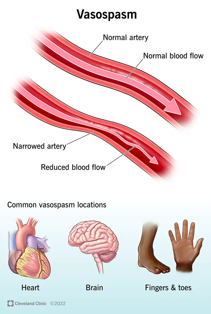 Vasospasmo che determina una riduzione del flusso sanguigno in un'arteria.