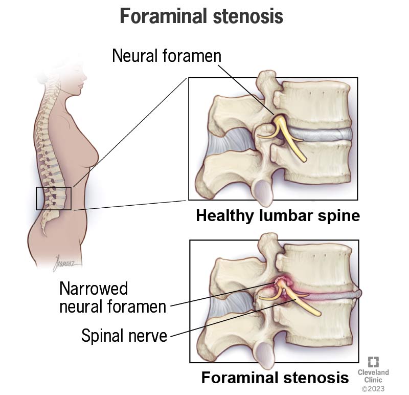 24856 foraminal stenosis