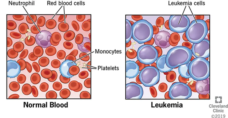 4365 leukemia