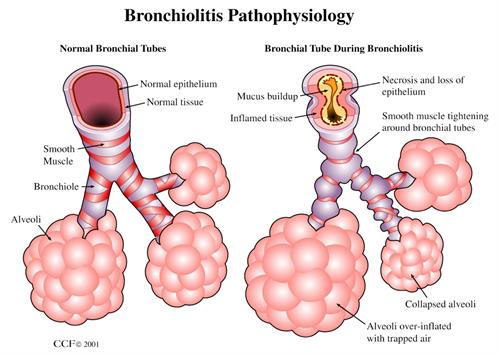 I normali bronchi sono aperti per far passare l'aria. Nella bronchiolite, i bronchi si restringono.