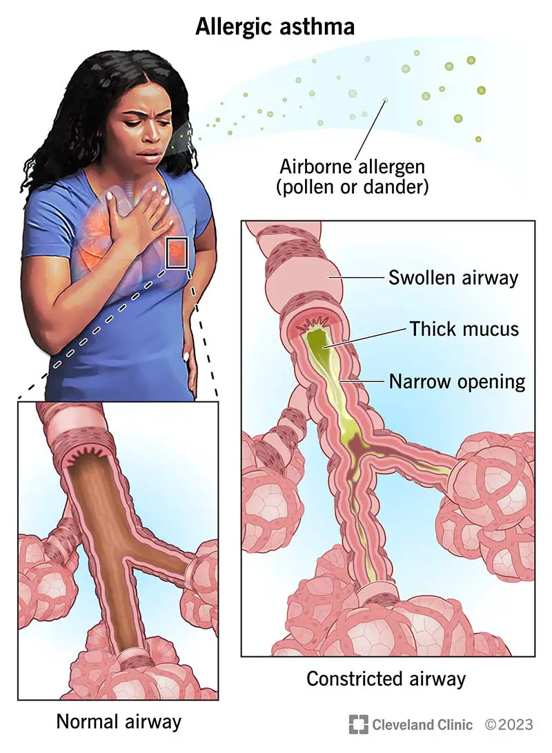 Donna con la mano sul petto dopo aver respirato un allergene presente nell'aria. Le sue vie aeree sono strette e piene di muco