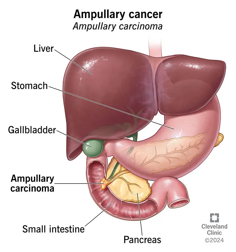 ampullary cancer