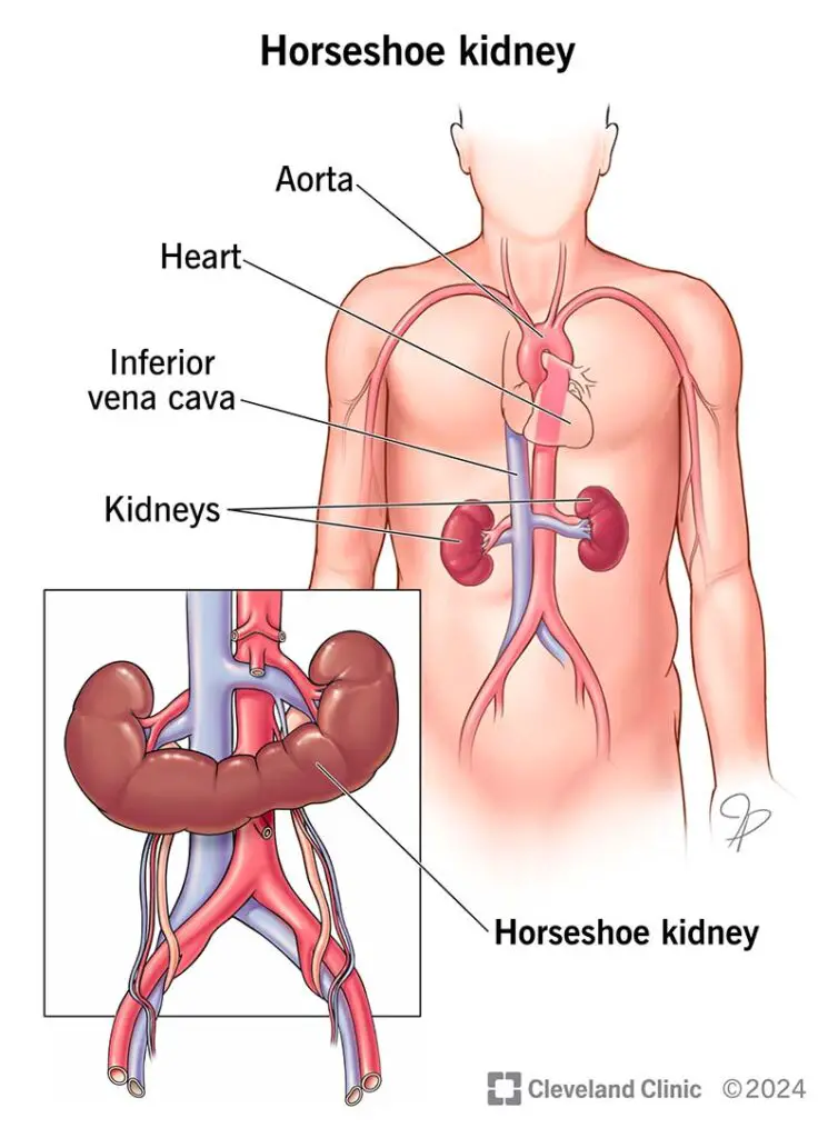 horseshoe kidney