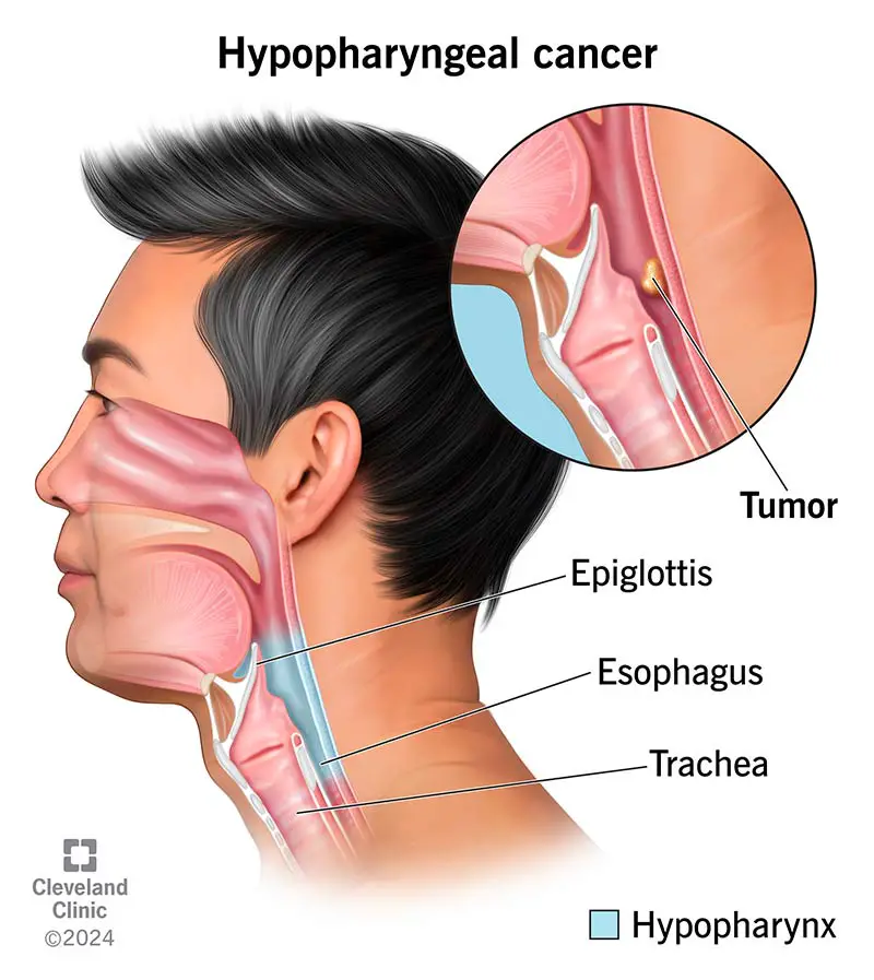 hypopharyngeal cancer