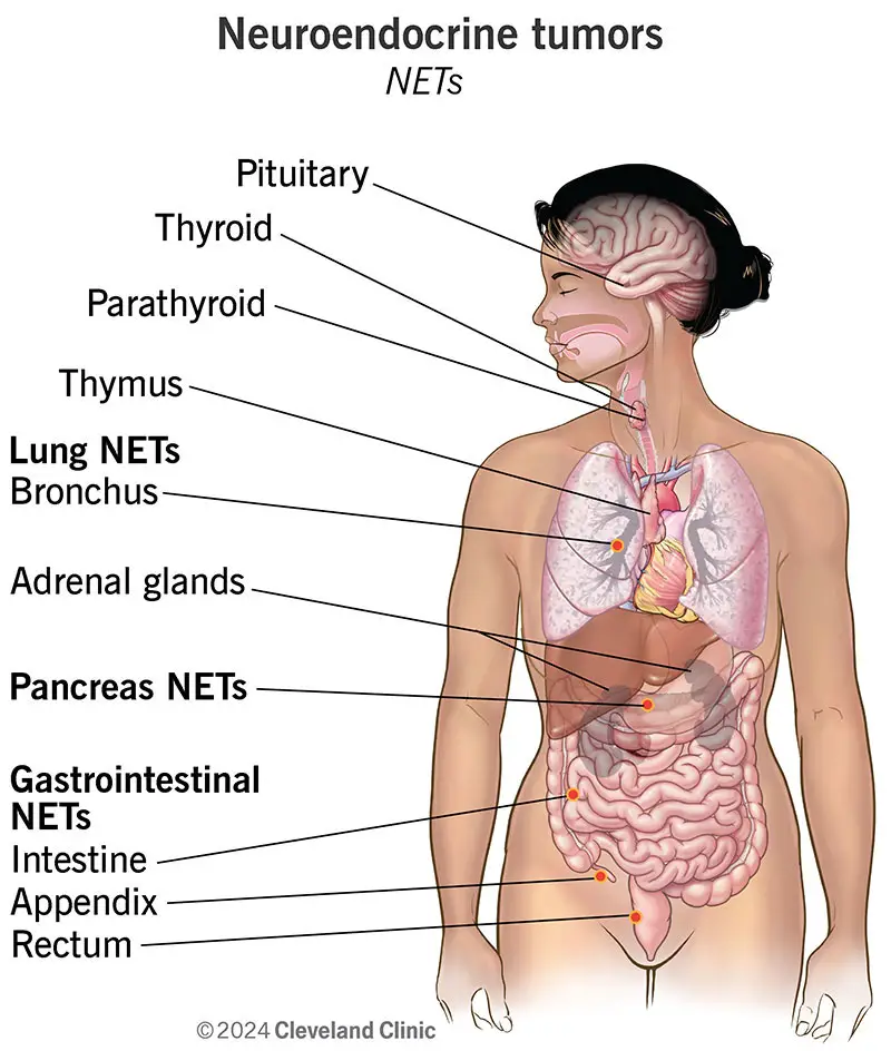 neuroendocrine tumors