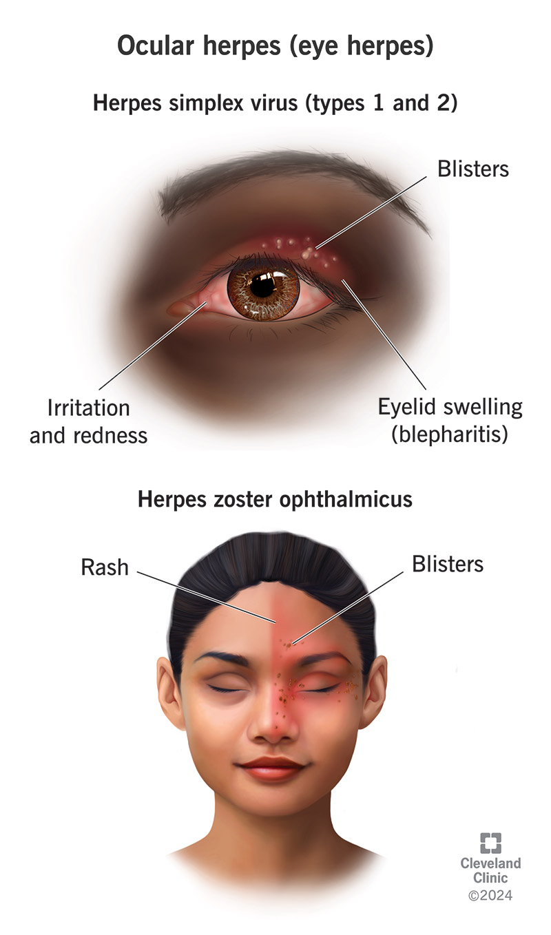 L'herpes oculare può causare vesciche e gonfiore sulla pelle del viso intorno agli occhi oppure irritazione e arrossamento degli occhi.