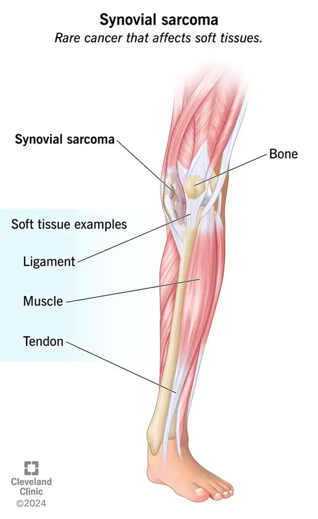 synovial sarcoma