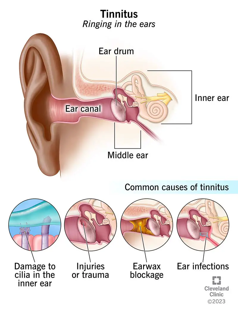 Anatomia dell'orecchio esterno, medio e interno e cause comuni dell'acufene.