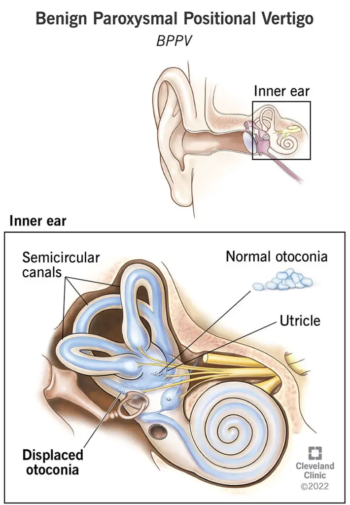 11858 benign paroxysmal positional vertigo