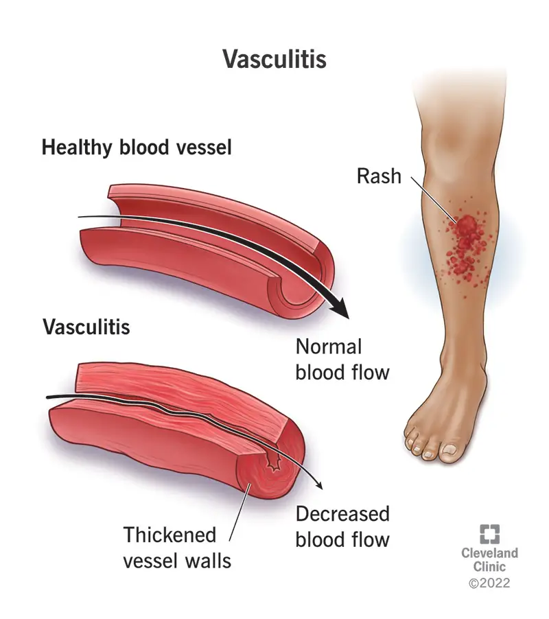 12101 vasculitis