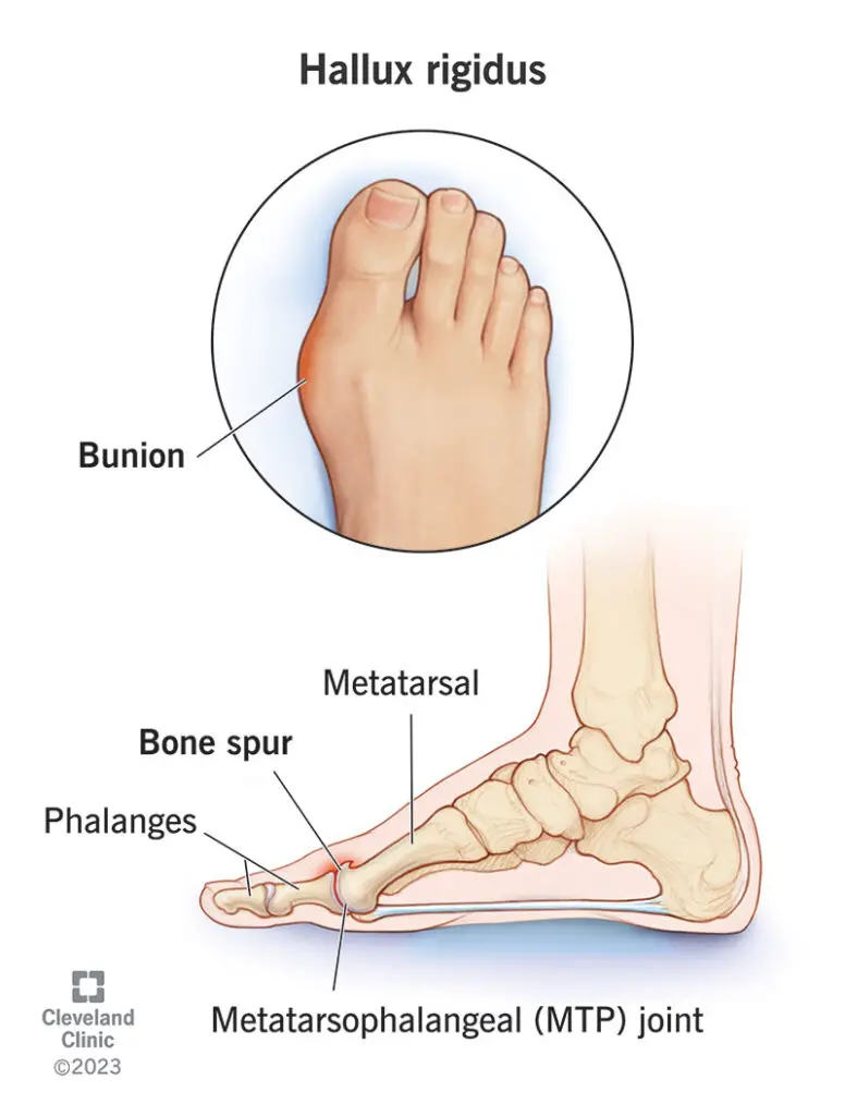 14665 hallux rigidus